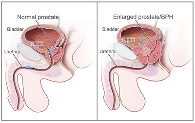 enlarged-prostate