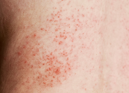 Difference Between Hives and Rash (1)