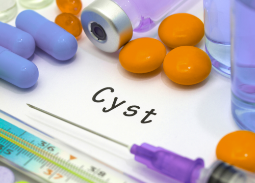 Difference Between Tumor and Cyst