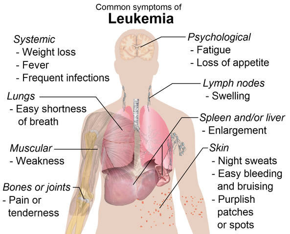 593px-Symptoms_of_leukemia