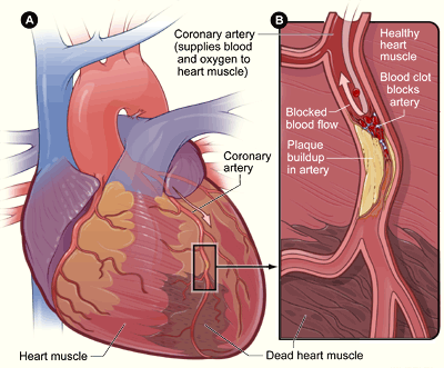 Diagram showing a heart attack (mycardial infaction)