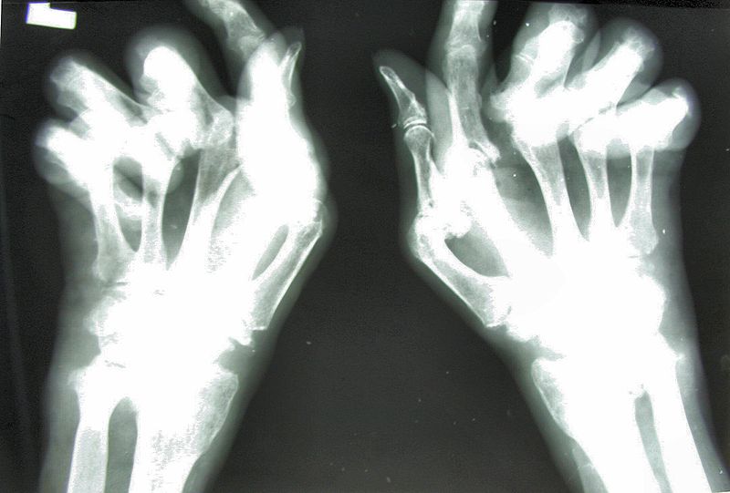 Rheumatoid arthritis - X-ray image of the hand