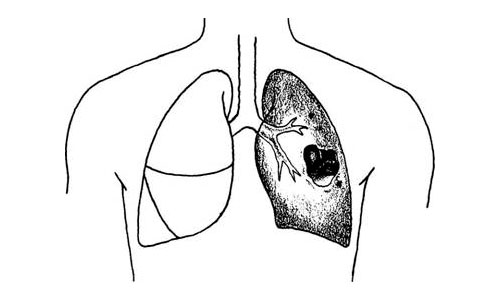pneumonia and lung abscess