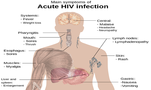 537px-Symptoms_of_acute_HIV_infection.svg