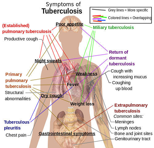 541px-Tuberculosis_symptoms.svg