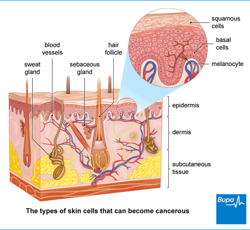 Take care of your skin! What you need to know about skin cancer (carcinomas and melanomas)-2