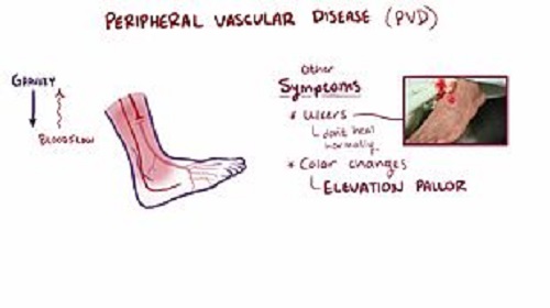 Undefined concepts unraveling the interpretations of Peripheral vascular disease (PVD) and Peripheral arterial disease (PAD)