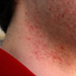 Difference between razor burn and herpes