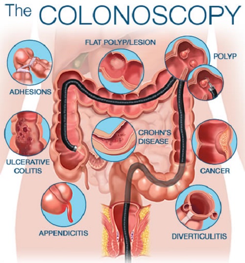 Difference between Sigmoidoscopy and Colonoscopy-1
