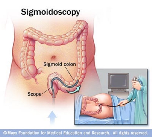 Difference between Sigmoidoscopy and Colonoscopy