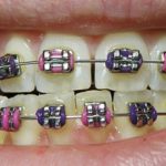 Difference between Ceramic and Metal Braces-1