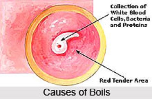 Difference between Pimple and Boil-1