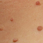 Difference Between Wart and Skin Tag