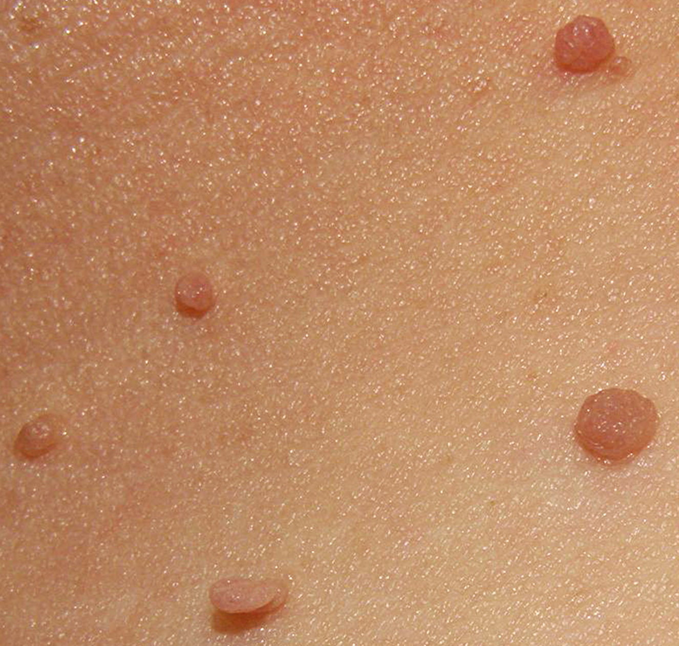 Difference Between Wart and Skin Tag