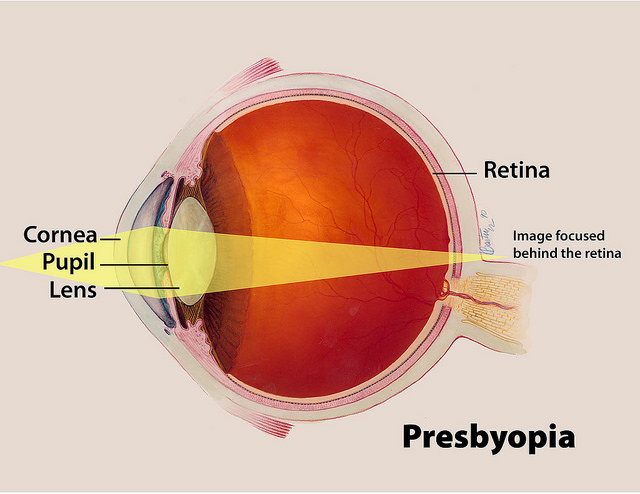 Difference between Hyperopia and Presbyopia 