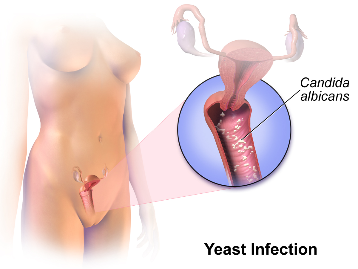 Difference Between Yeast Infection and Bacterial Vaginosis