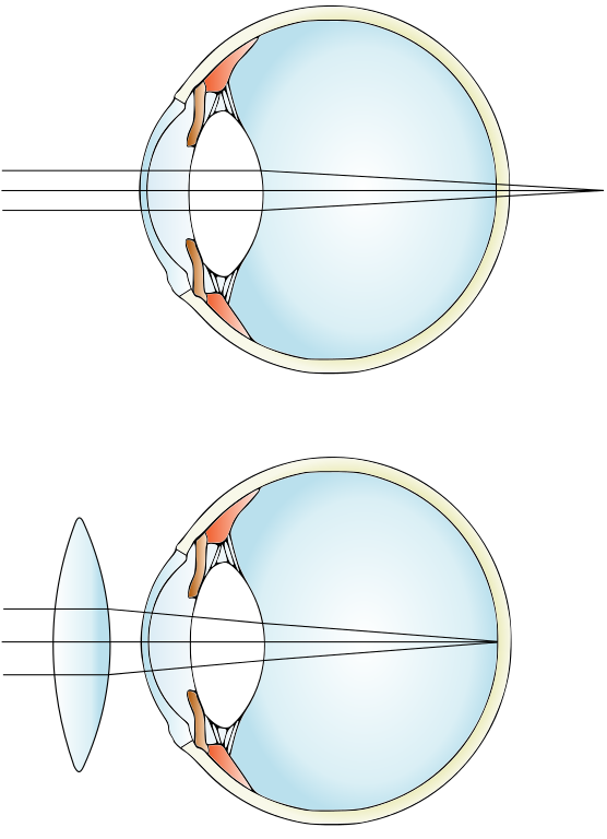 Difference between Myopia and Hypermetropia