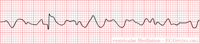 Difference Between Ventricular Tachycardia (Vtach) and Ventricular Fibrillation (Vfib)