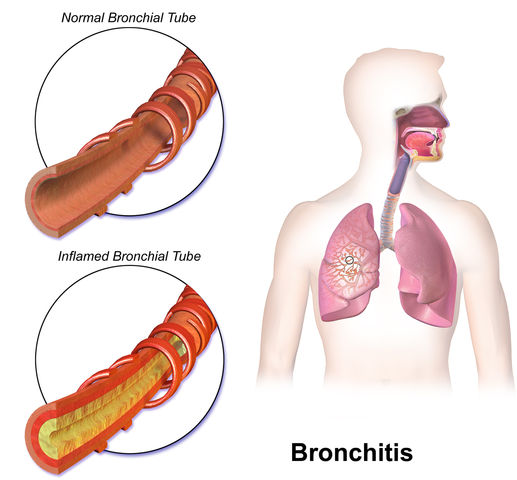 Difference Between Bronchitis and Cold
