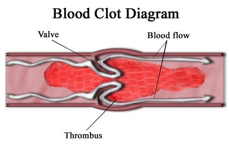 Difference Between Blood Clots and Tissue