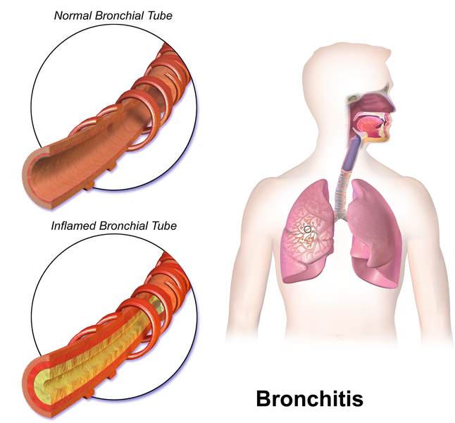 Difference Between Upper Respiratory Infection and Bronchitis