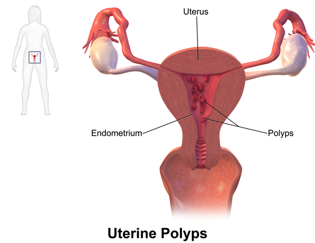 Difference Between Polyps and Fibroids