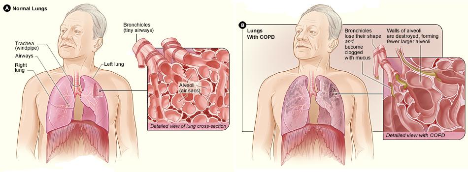 Difference between COPD and Pulmonary  Fibrosis