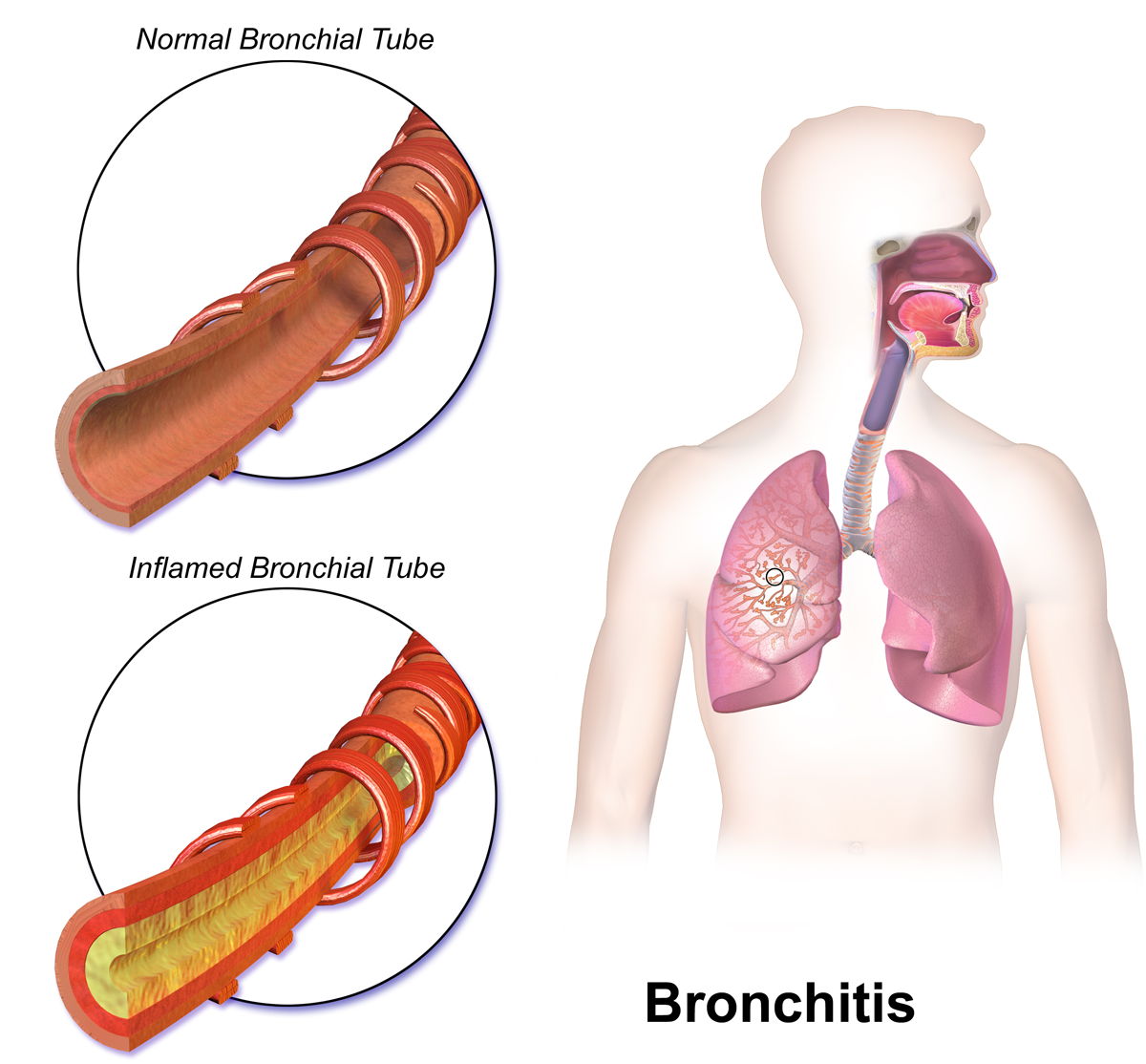 Difference Between Bronchitis and Acute Bronchitis
