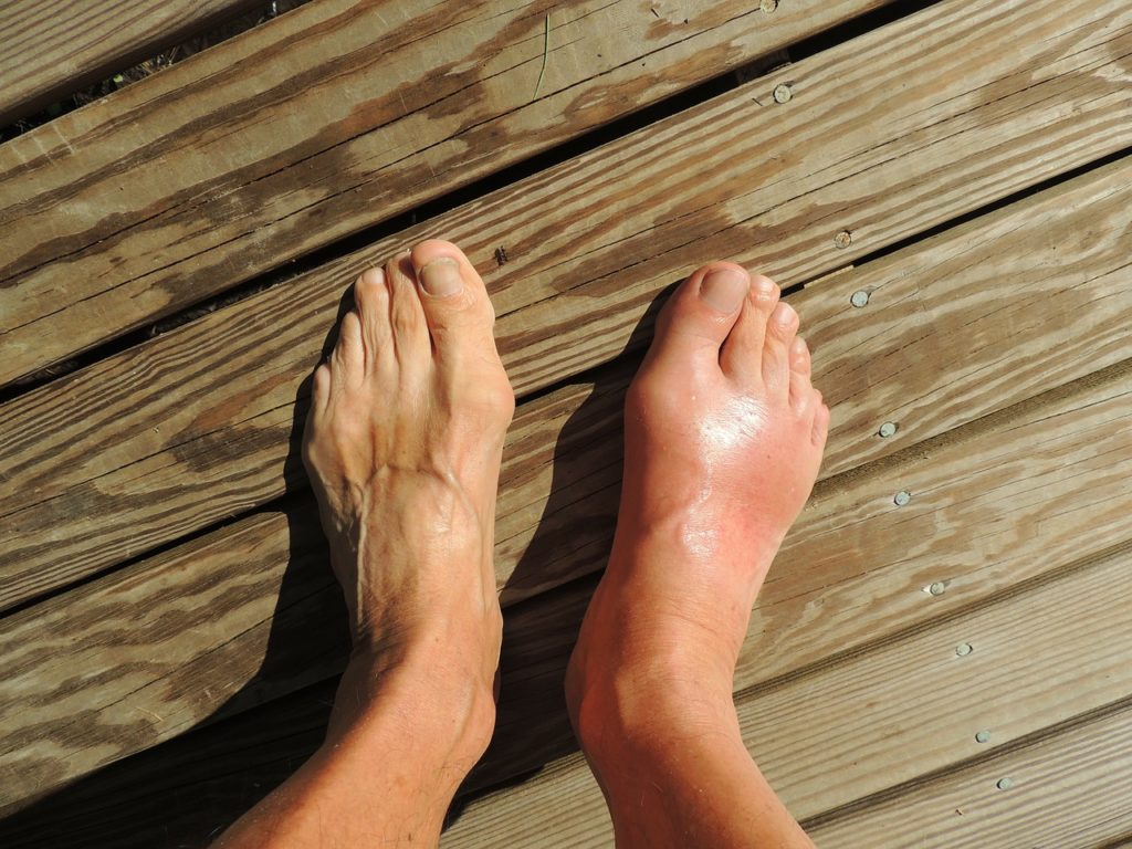 Gout and Turf Toe: Similarities and Differences
