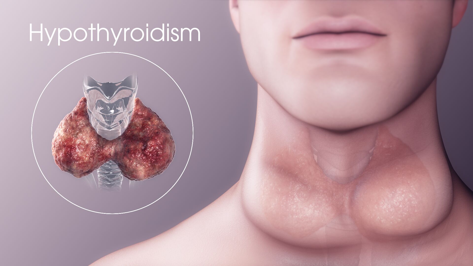 Difference Between Hashimoto’s and Hypothyroidism