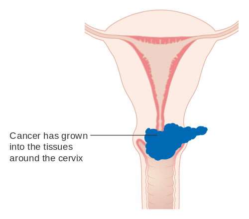Difference Between Cervical Cancer vs Ovarian Cancer