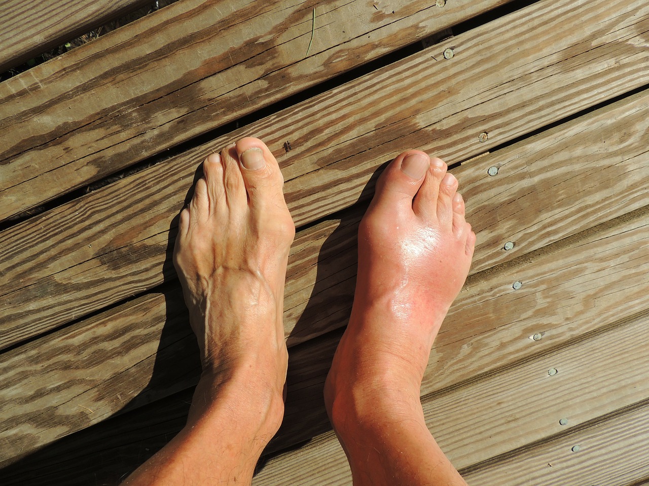 Difference Between Gout and Tendonitis