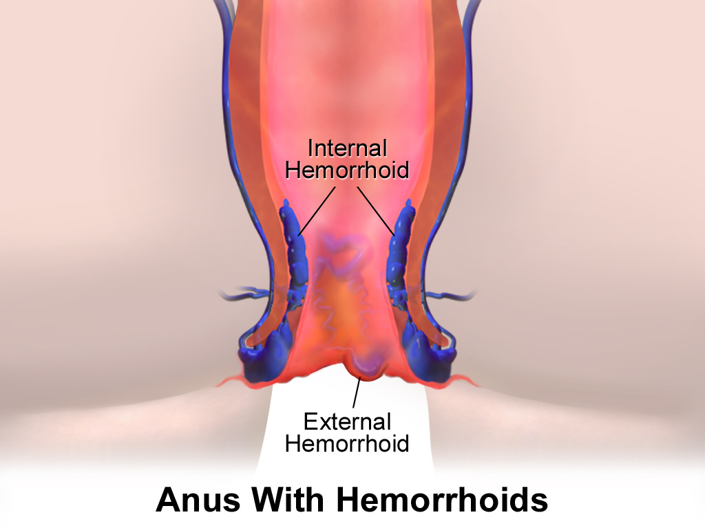 Difference Between Fistula and Hemorrhoids