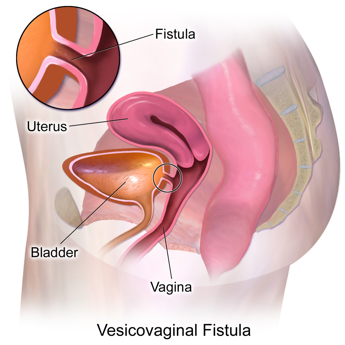 Difference Between Fistula and Shunt