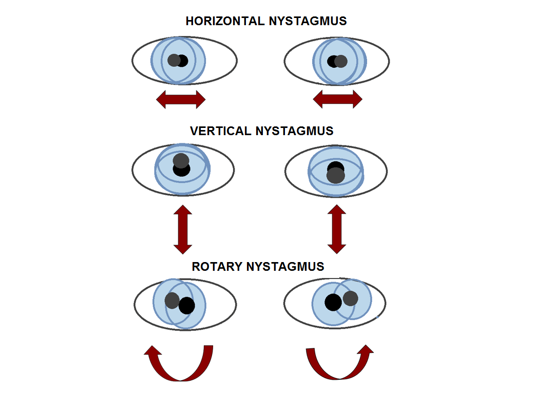 Difference Between Horizontal Nystagmus and Vertical Nystagmus