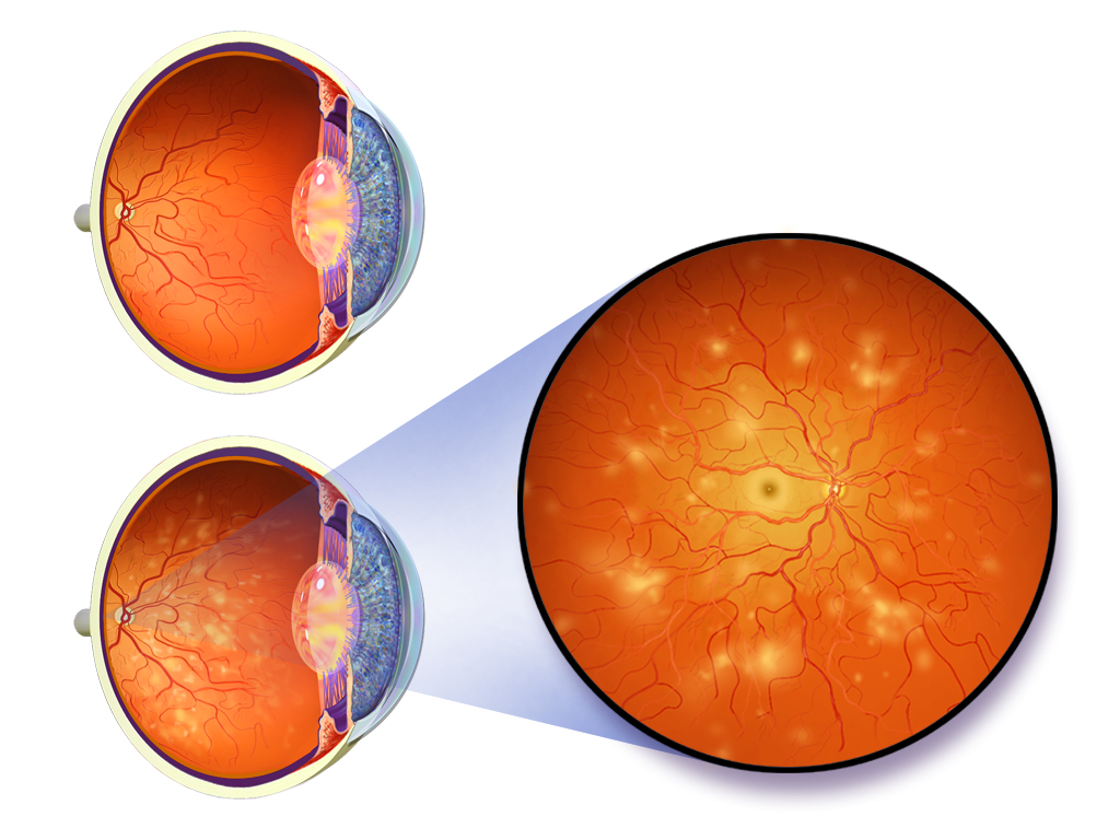 Difference Between Diabetic Retinopathy and Macular Degeneration