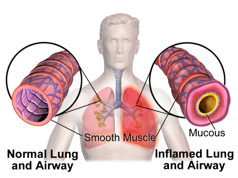 Difference Between Acute And Chronic Asthma Exacerbation Difference