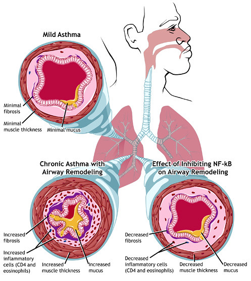 Difference Between Extrinsic Asthma and Intrinsic Asthma