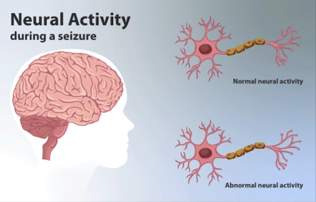 Difference Between Seizure and Passing out