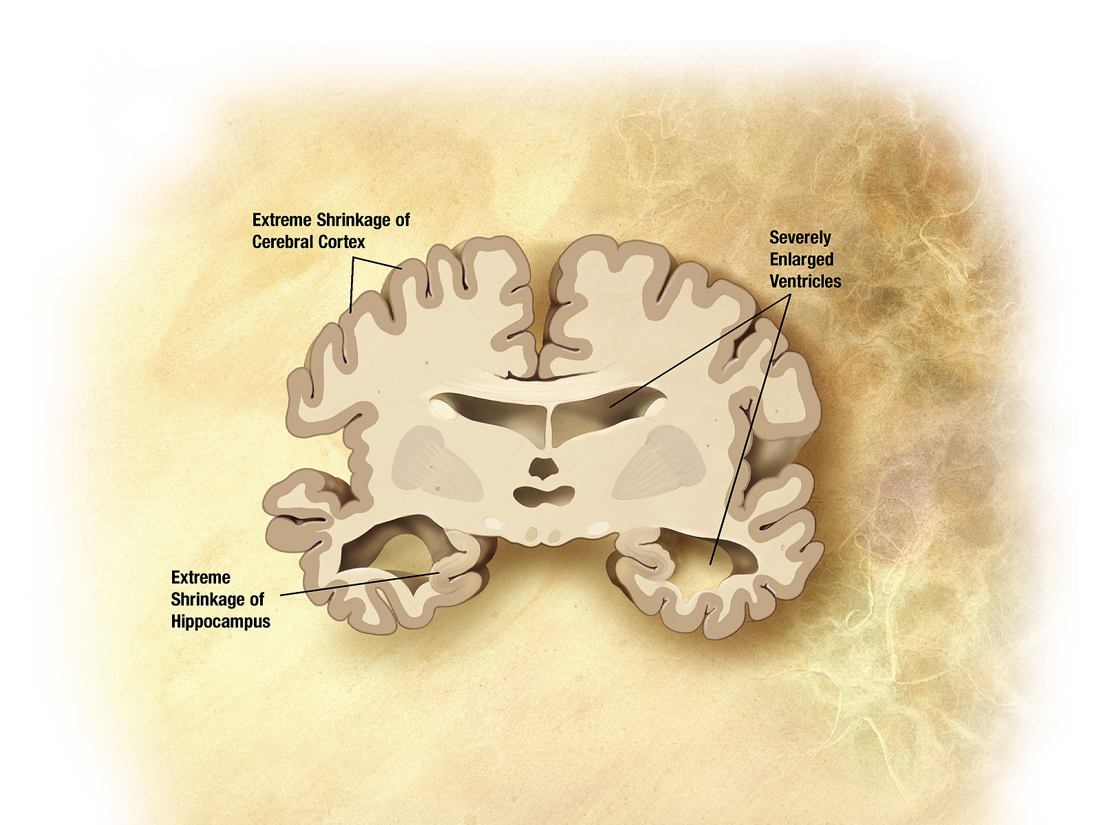 Difference Between Alzheimer's Disease and Dementia with Lewy Bodies