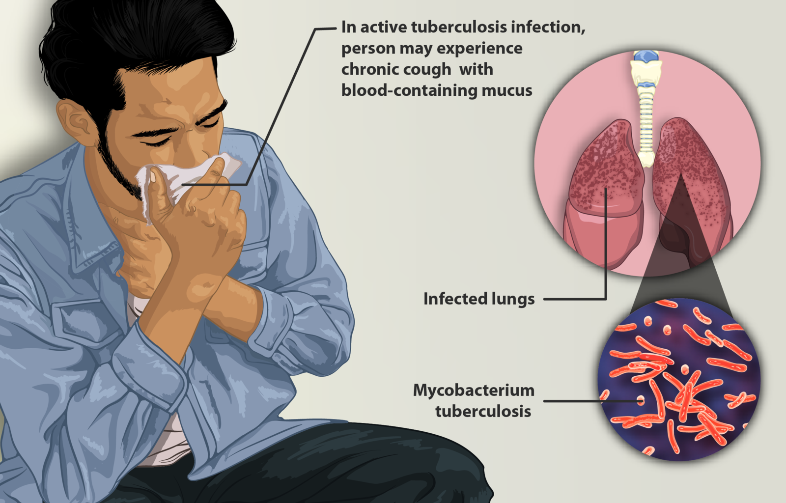 Difference Between Coronavirus and Tuberculosis