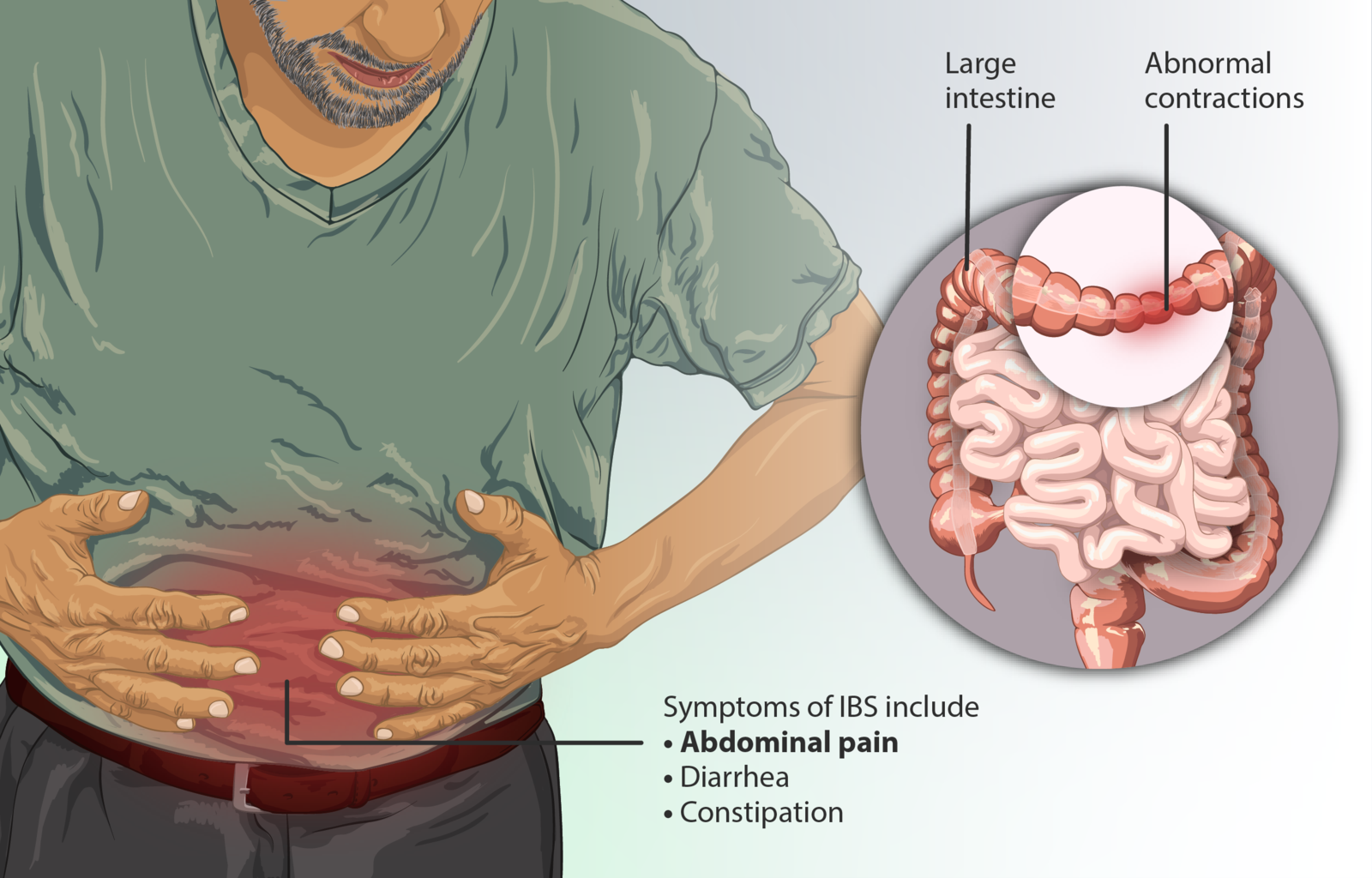 Difference Between Irritable Bowel Syndrome (IBS) and Ulcerative Colitis