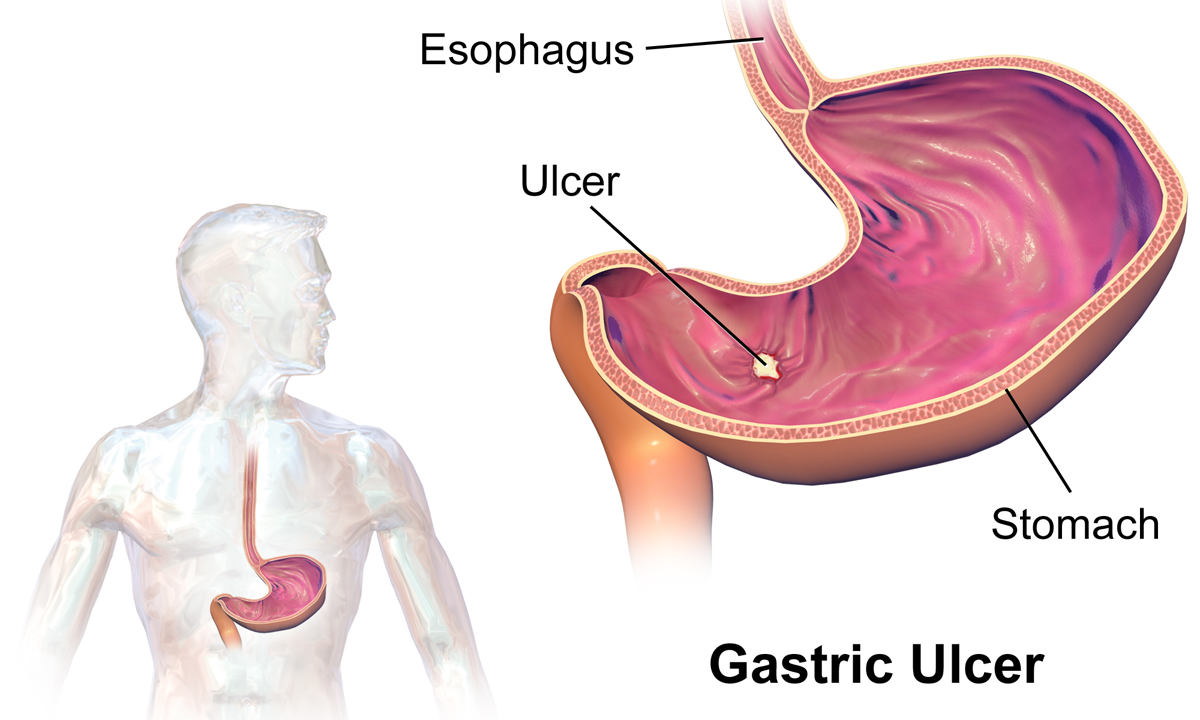 Difference Between Hernia and Ulcer