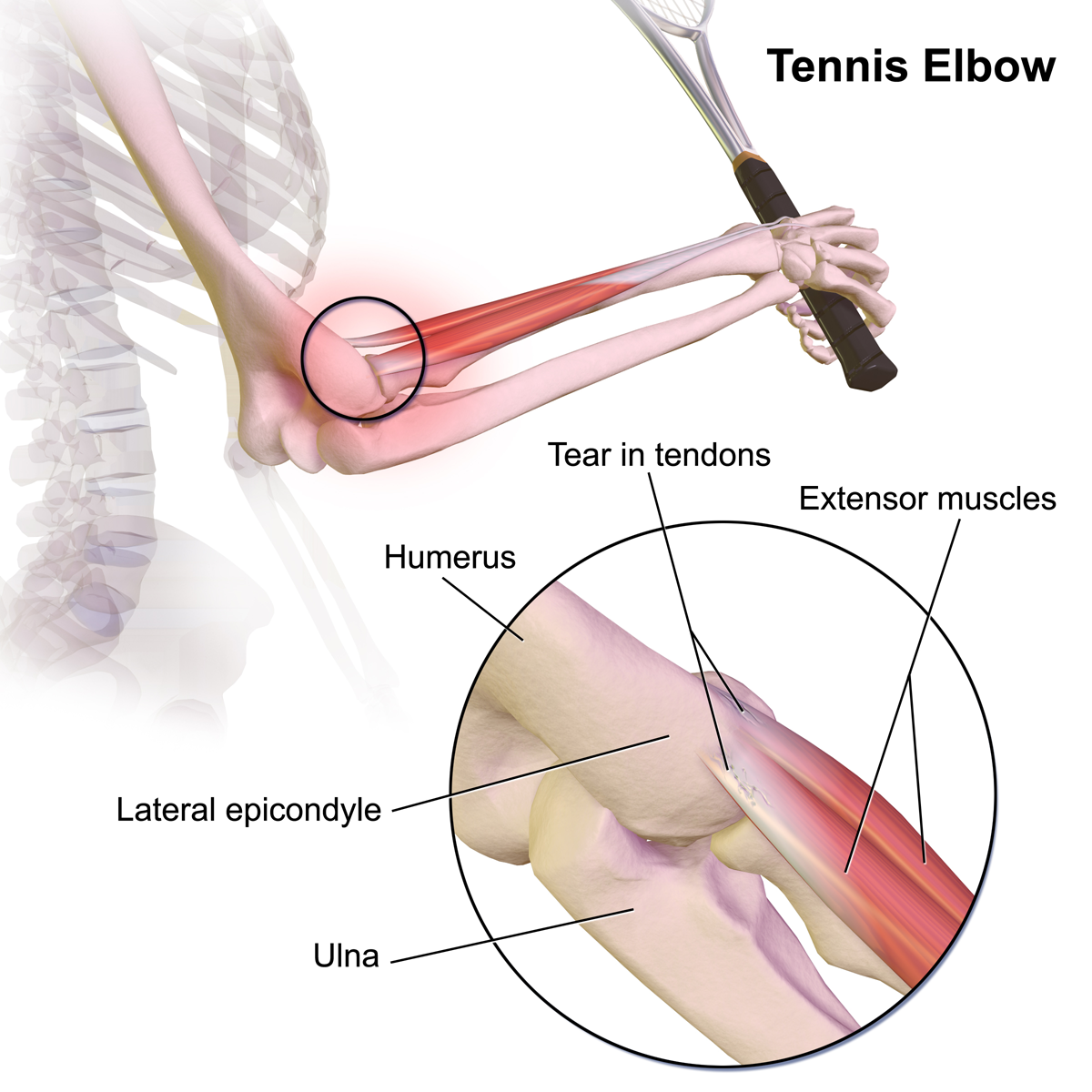 Difference Between Tennis Elbow and Golfer’s Elbow