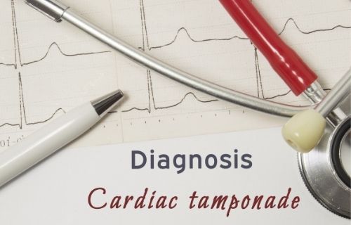 Difference Between Pericarditis and Cardiac Tamponade