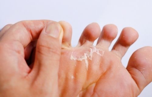 Difference Between Ringworm and Athlete's Foot