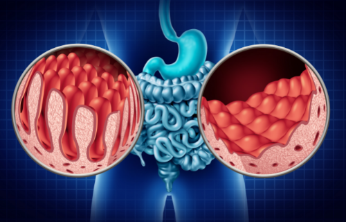 Difference Between Celiac Disease and Ulcerative Colitis (1)