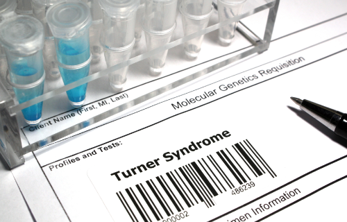 Difference Between Turner Syndrome and Down Syndrome (1)