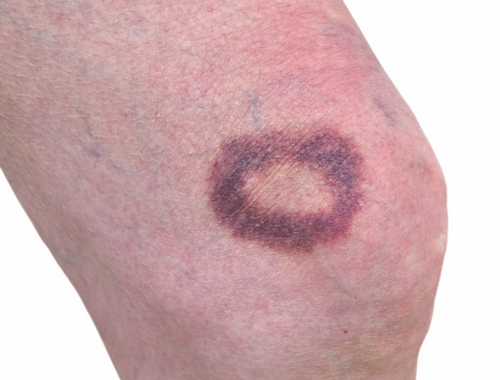 Difference Between Hematoma and Seroma