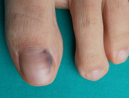 Is the Black Line on Your Nail Normal or Melanoma? How To tell